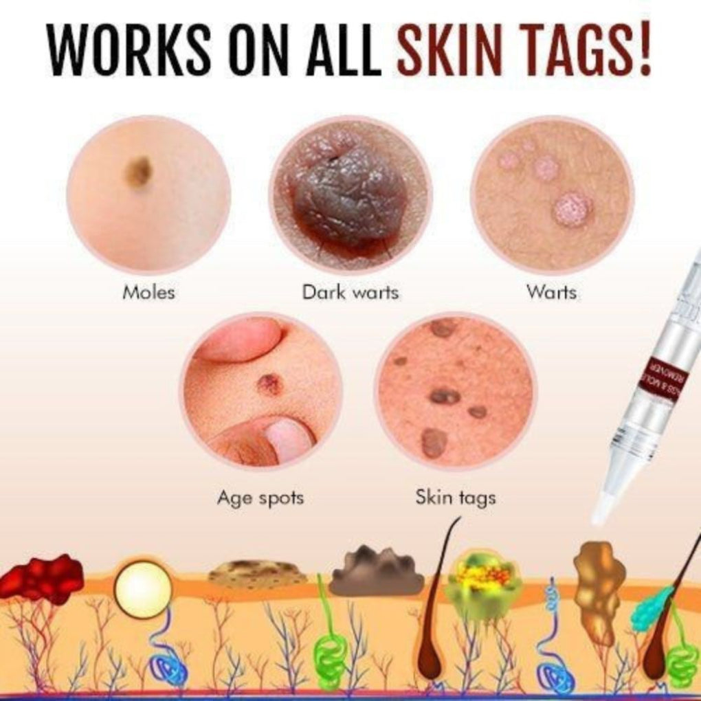 Natural Skin Tag & Mole Remover Pen