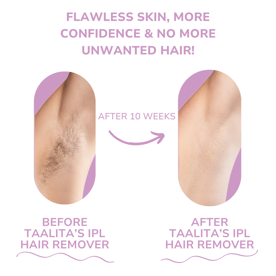 SHOPAVERLY IPL Hair Remover | The leading laser hair removal for your home